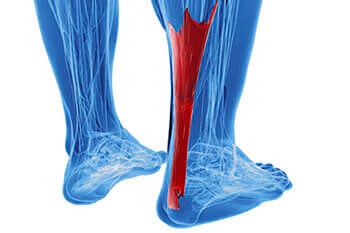 achilles tendonitis treatment in the Dallas, TX 75231, Athens, TX 75751 and Gun Barrel City, TX 75156 area