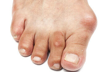 bunions treatment in Dallas, Athens and Gun Barrel City, TX