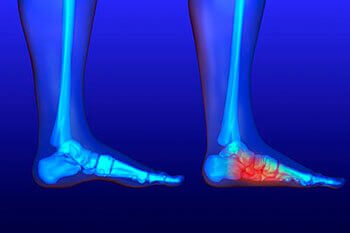 Flat feet and Fallen Arches treatment in the Dallas, TX 75231, Athens, TX 75751 and Gun Barrel City, TX 75156 area