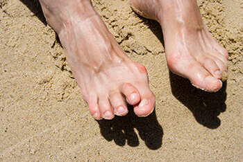 hammertoes treatment in the Dallas, TX 75231, Athens, TX 75751 and Gun Barrel City, TX 75156 area