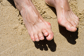 hammertoes treatment in the Dallas, TX 75231, Athens, TX 75751 and Gun Barrel City, TX 75156 area