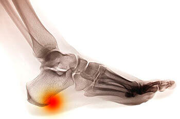 Heel spurs treatment in Dallas, TX 75231, Athens, TX 75751 and Gun Barrel City, TX 75156 area