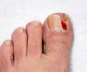 Ingrown toenails treatment in Dallas, TX 75231, Athens, TX 75751 and Gun Barrel City, TX 75156 area