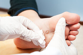 Plantar warts treatment in the Dallas, TX 75231, Athens, TX 75751 and Gun Barrel City, TX 75156 area