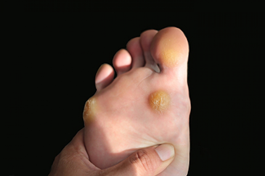 Preventing corns on feet on sale